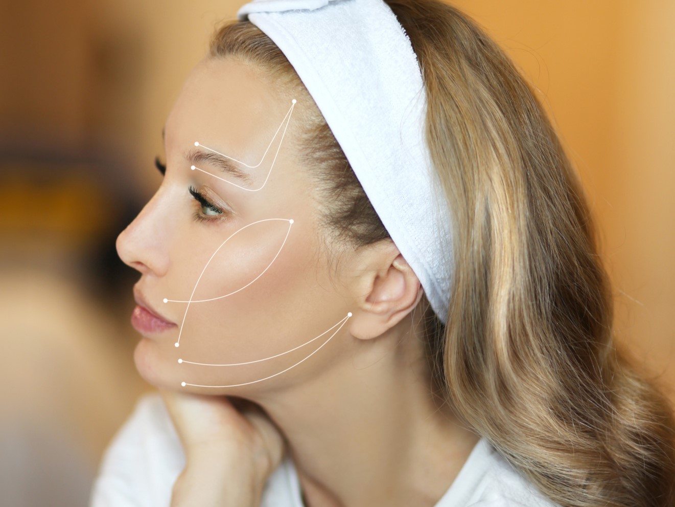 Seidenfadenlifting Behandlung bei BAlm Aesthetics in Voerde