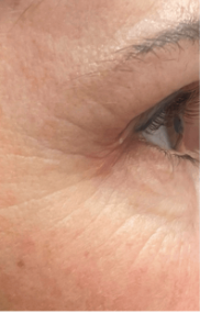 Augenpartie nach der Mesoporation Behandlung bei BAlm Aesthetics – vorher