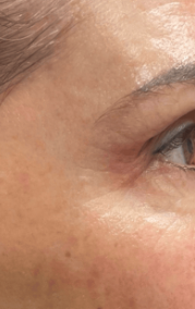 Augenpartie nach der Mesoporation Behandlung bei BAlm Aesthetics – nachher