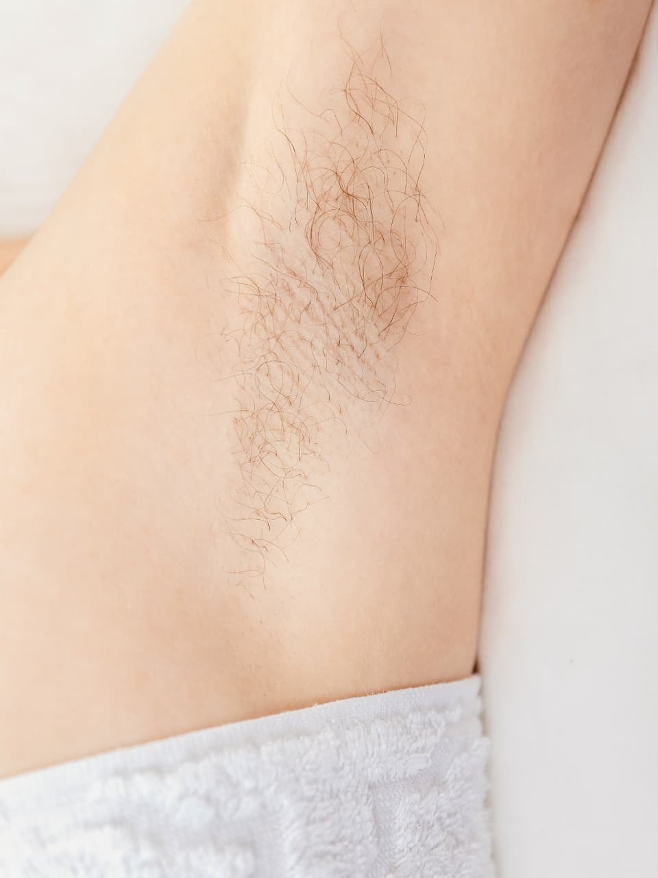 Achsel nach der dauerhaften Haarentfernung bei BAlm Aesthetics – vorher