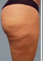 Oberschenkel nach der G5 Problemzonenmassage & Bodyforming Behandlung bei BAlm Aesthetics – vorher