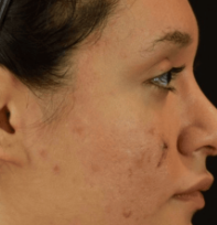 Hautbild nach der Microneedling Behandlung bei BAlm Aesthetics – nachher