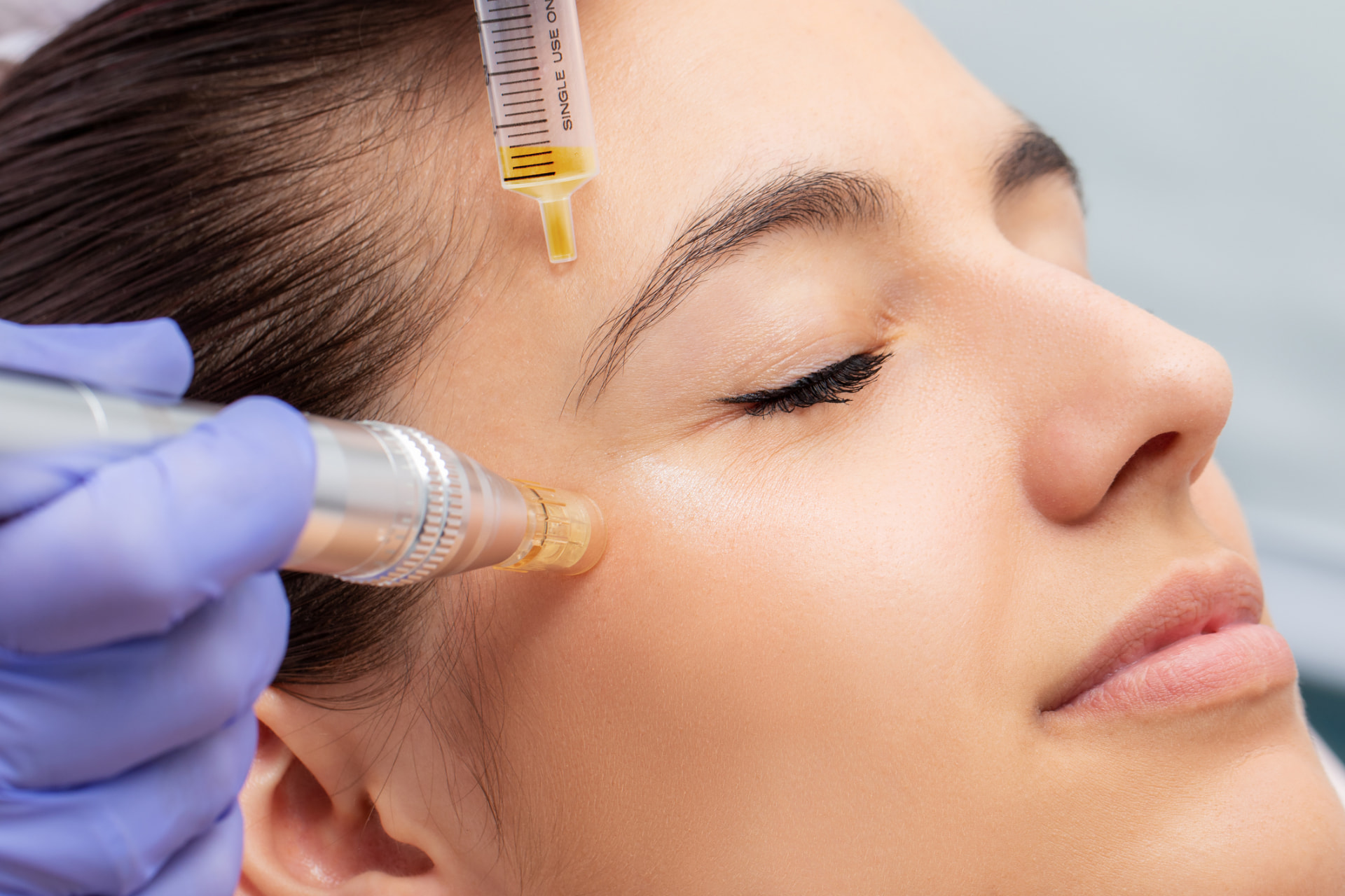Mesoporation mit Belico bei BAlm Aesthetics in Voerde