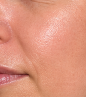 Hautbild nach der AquaFacial Behandlung bei BAlm Aesthetics – nachher