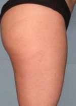 Oberschenkel nach der G5 Problemzonenmassage & Bodyforming Behandlung bei BAlm Aesthetics – nachher