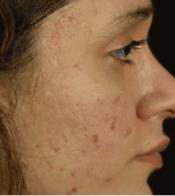 Hautbild nach der Microneedling Behandlung bei BAlm Aesthetics – vorher