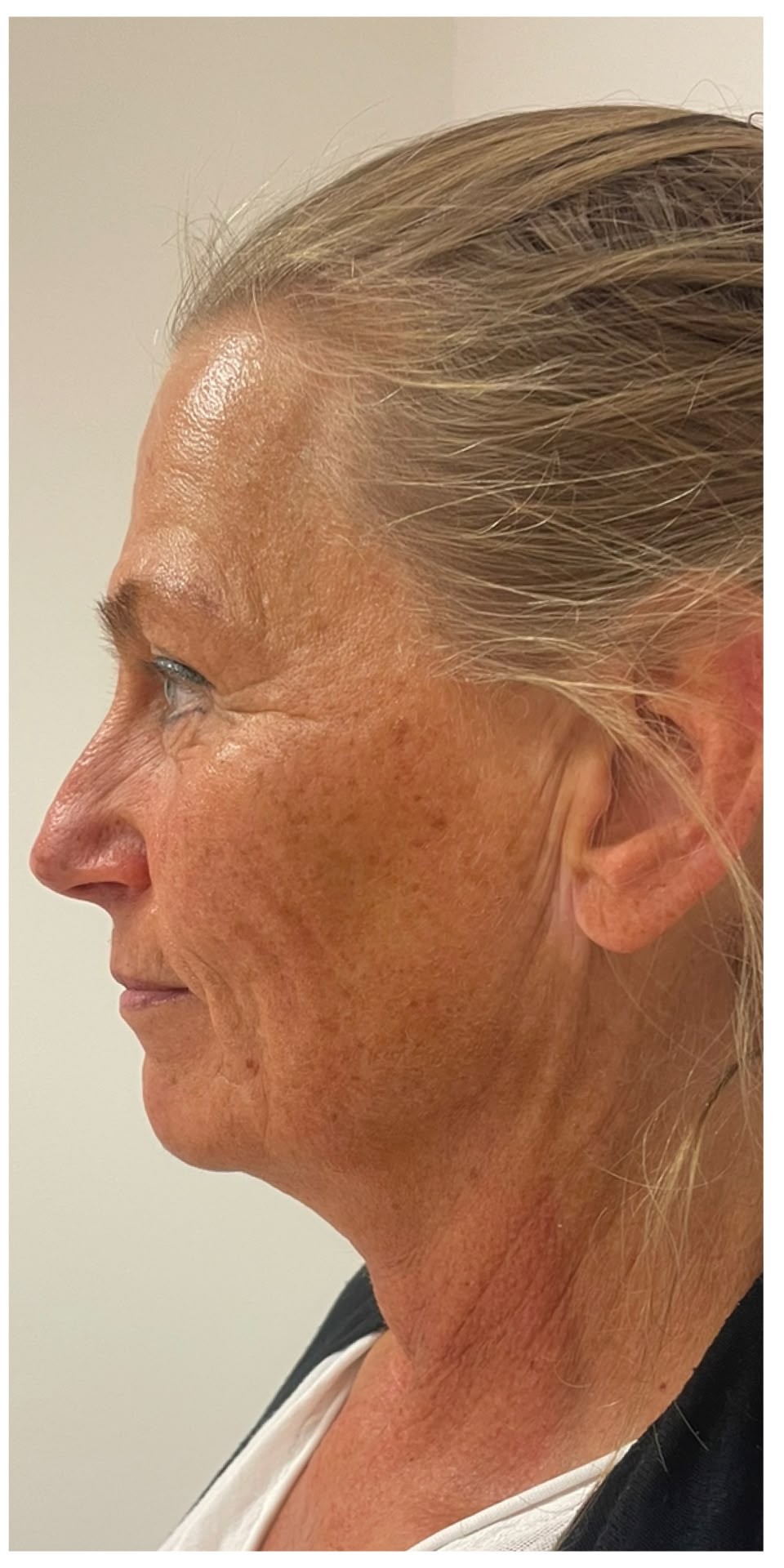 Profil mit sichtbar strafferer Kontur nach der FUTURACONTOUR® Behandlung – nachher
